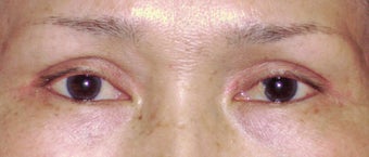 Upper Blepharoplasty