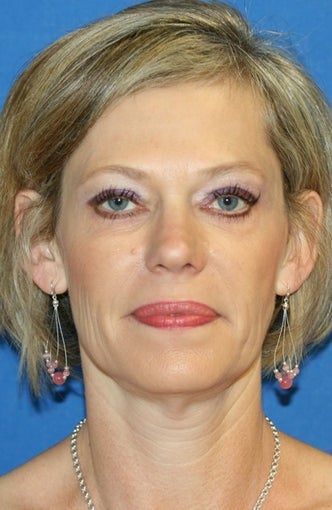 Eye Rejuvenation