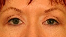 Upper Blepharoplasty (Upper Eyelids)