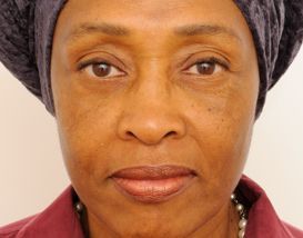 Lower Blepharoplasty (Lower Eyelids)