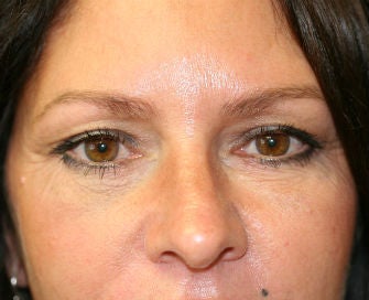 Lower eyelid blepharoplasty