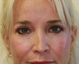 Eyelid rejuvenation