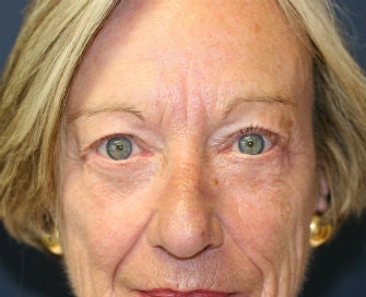 eyelid blepharoplasty