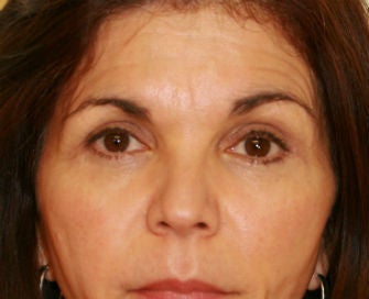 Lower eyelid blepharoplasty