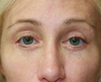 Eyelid rejuvenation