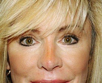 eyelid procedure