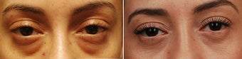 Bilateral Upper Eyelid Blepharoplasty