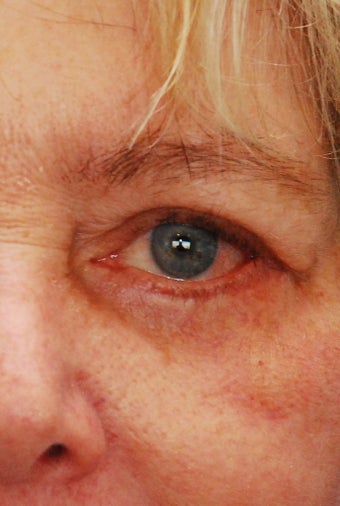 Lower eyelid reconstruction