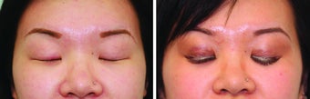 Double Eyelid Surgery Suture
