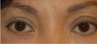 Ptosis Correction