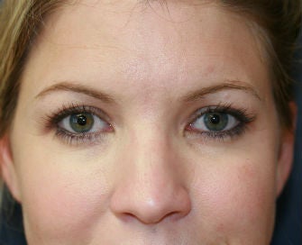 blepharoplasty