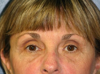 Blepharoplasty