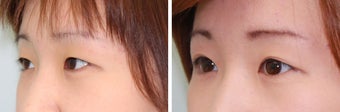 Double Eyelid Surgery - Suture Technique