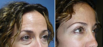 Cosmetic eyelid surgery