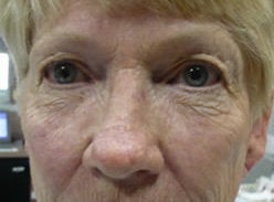 Cosmetic eyelid surgery