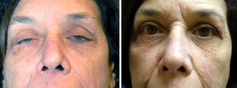 Ptosis (Droopy Eyelid)