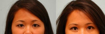 Asian Blepharoplasty ("Double Eyelid" Procedure)