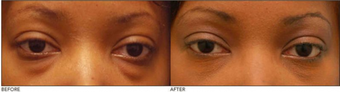 Lower Eyelid Blepharoplasty
