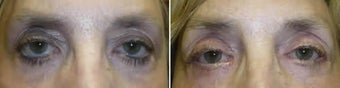 Revisional Eyelid Surgery