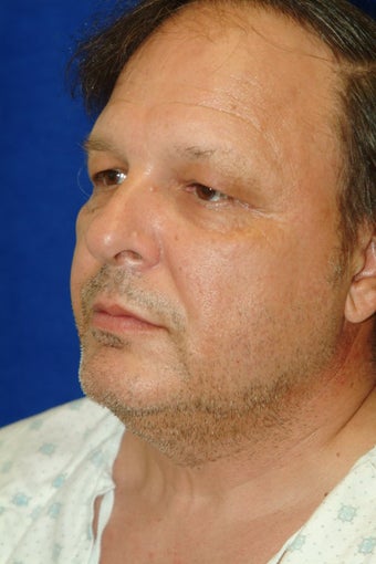 Before and after blepharoplasty