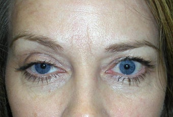 Ptosis Repair and Blepharoplasty