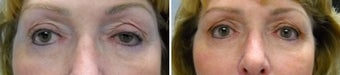 Left upper eyelid ptosis repair