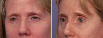 Eyelid Surgery