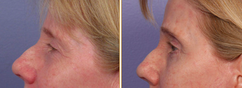 Eyelid Surgery