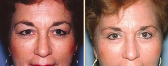 Eyelid Surgery