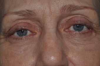 Bilateral upper and lower blepharoplasty, and 4 lid permanent eyeliner