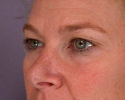 Eyelid Surgery