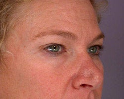 Eyelid Surgery