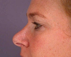 Eyelid Surgery