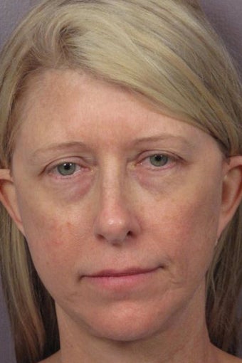Eyelid Surgery