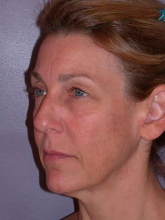 Eyelid Surgery