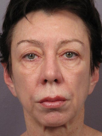 Eyelid Surgery 