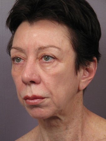 Eyelid Surgery