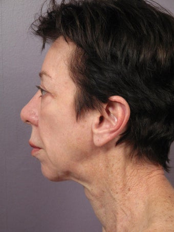 Eyelid Surgery