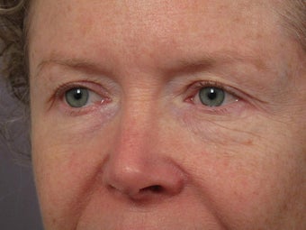 Eyelid Surgery