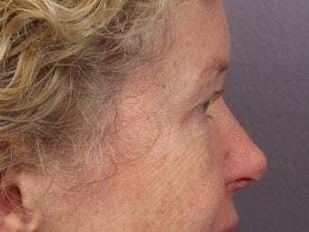Eyelid Surgery