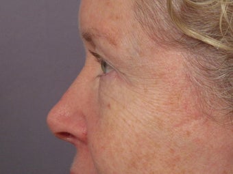 Eyelid Surgery