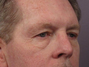 Eyelid Surgery