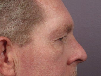 Eyelid Surgery