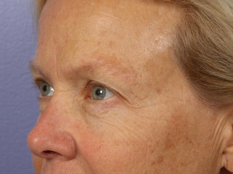 Eyelid Surgery