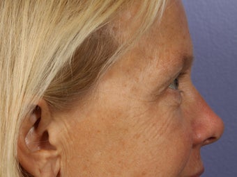 Eyelid Surgery 