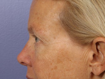 Eyelid Surgery