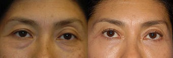 Blepharoplasty-Mid-Face