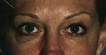 Upper and lower eyelid (blepharoplasty) Surgery