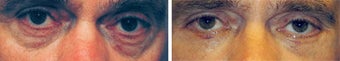Blepharoplasty-Mid-Face