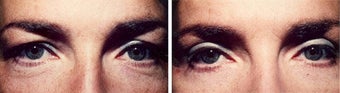 Blepharoplasty-Mid-Face